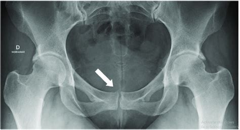 Osteoarthritis symptoms often develop slowly and worsen over time. . Pubic symphysis osteoarthritis